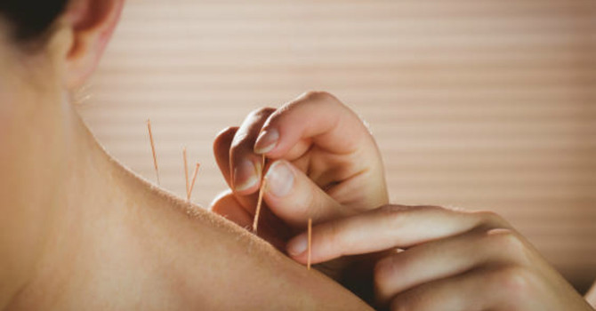 The Science Behind Acupuncture: Understanding How It Works image