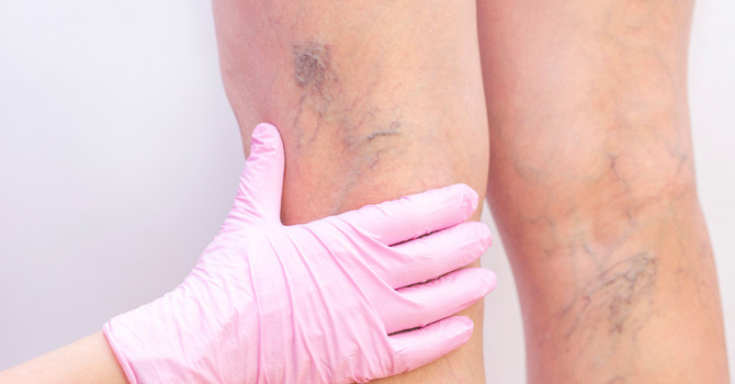 Who Can Benefit from Sclerotherapy? image