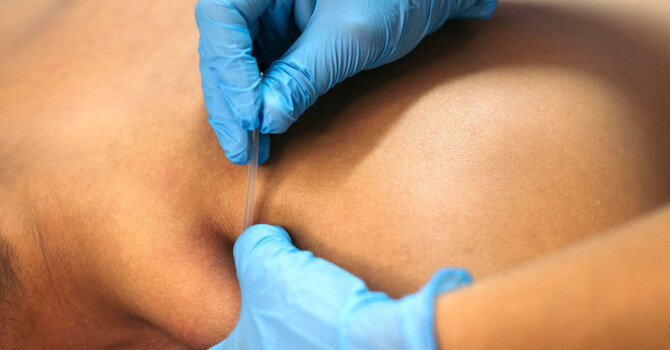 What to Expect at Your First Dry Needling Session image